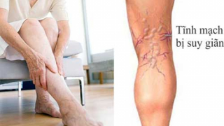 Nguy cơ giãn tĩnh mạch cao nhất ở nữ giới