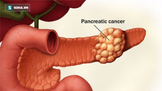 Cảnh bảo ung thư từ dấu hiệu đau bụng