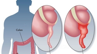 Viêm ruột thừa cấp là gì và viêm ruột thừa cấp có phải mổ không?