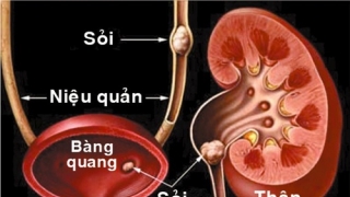 Hi hữu bệnh nhi nữ bị sỏi thận... to bằng viên bi