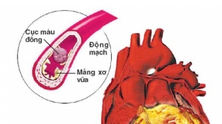 Thông tin mới nhất về bệnh tim mạch vành