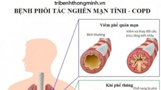 Thông tin về bệnh tắc nghẽn phổi mãn tính