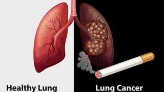 Người có 6 thói quen này có tỉ lệ mắc ung thư phổi rất cao