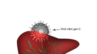 Viêm gan siêu vi C và các biến chứng thường gặp