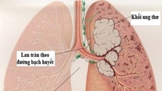 Dấu hiệu sớm của ung thư phổi không nên bỏ qua