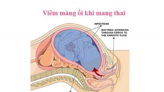 Nguyên nhân viêm màng ối và những điều không tốt cho thai nhi, mẹ bầu nên biết