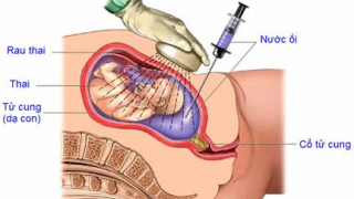 Chỉ số nước ối tuần 29 như thế nào?