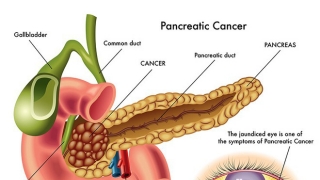 Viêm tuỵ cấp - diễn biến nhanh, cực nguy hiểm: Thể hoại tử chỉ còn 1% cơ hội sống sót
