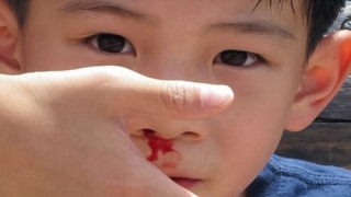 Những điều cần lưu ý trong cách chăm sóc trẻ bị hemophilia tại nhà