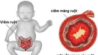 Căn bệnh bẩm sinh khiến ruột trẻ bị hoại tử nhanh chóng