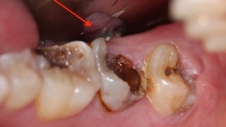 Chuyện gì sẽ xảy ra nếu bạn có một chiếc răng sâu và không chịu chữa trị ngay?