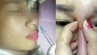 Mù mắt vì làm đẹp bằng filler nhưng nhiều người vẫn liều mạng