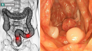 5 dấu hiệu điển hình cảnh báo khối u ung thư đại trực tràng đang phát triển 'thần tốc'