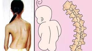 Cách chăm sóc trẻ bị cong vẹo cột sống