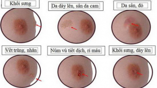 4 bước tự khám vú phụ nữ cần biết
