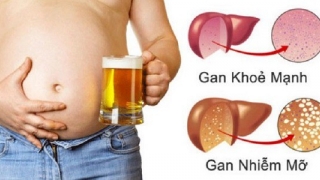 Gan nhiễm mỡ là 'bước đệm' dẫn đến xơ gan và ung thư: 6 nguy cơ ai cũng cần biết để phòng