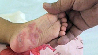 BS bệnh viện Nhi khuyến cáo 4 việc cần làm ngay để phòng tránh chân tay miệng