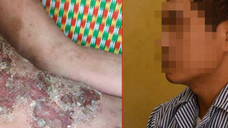 Thích ăn tiết canh, rau sống, nem chua, người đàn ông bị đau gan vì nguyên nhân không ngờ