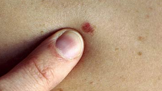 Những dấu hiệu của nốt ruồi cần cảnh giác