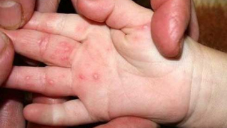 Cách phòng tránh bệnh tay chân miệng ở trẻ em