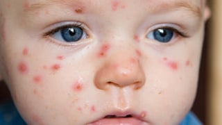 Cách điều trị dứt điểm bệnh chân tay miệng ở trẻ em