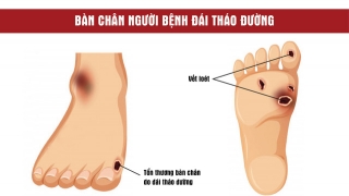 5 Sai lầm khi chăm sóc bàn chân người tiểu đường mùa lạnh