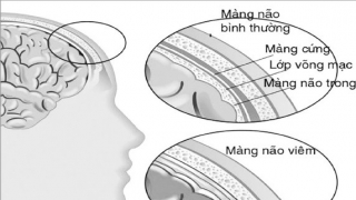 Cảnh giác bệnh viêm màng não do giun lươn