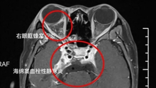 Cô gái 19 tuổi bị nhiễm trùng nội sọ vì thói quen nặn mụn trên mặt