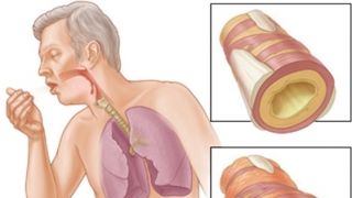 Căn bệnh kì lạ 'ho ra máu sét đánh' khiến bệnh nhân và bác sĩ phải chạy đua với tử thần