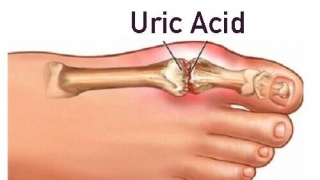 Cháu bé 13 tuổi mắc acid uric gấp đôi người lớn, thận bị tổn thương