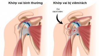 Nhân viên văn phòng có thể bại liệt nếu chủ quan