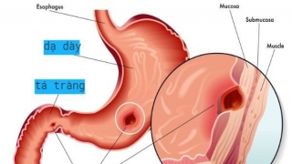 Viêm loét dạ dày có thể gây biến chứng nguy hiểm nào?