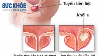 Đối tượng có nguy cơ cáo mắc ung thư tiền liệt tuyến