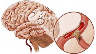 Khi xuất hiện đủ 5 triệu chứng này rất có thể xuất huyết não, hãy đi bệnh viện ngay