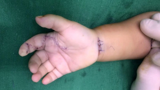 Cầm phải sâu róm, bé 1 tuổi bị viêm thành ổ mủ vì sai lầm của cha mẹ