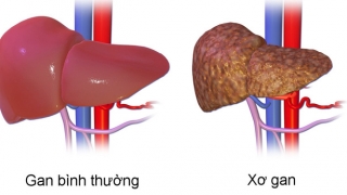 7 nhóm người có lá gan 'phản chủ': Hãy cẩn thận vì nó đang xơ hóa, có thể dẫn đến ung thư