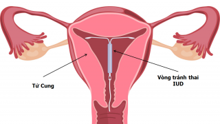 Cách hoạt động của vòng tránh thai