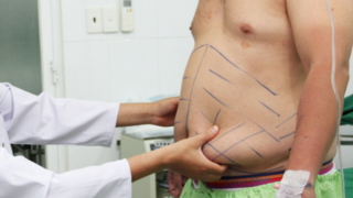 Có nên hút mỡ bụng?