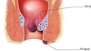 10 cách hiệu quả để thoát khỏi bệnh trĩ  ngay tại nhà