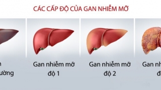 Gan nhiễm mỡ độ 1 có cần điều trị không?