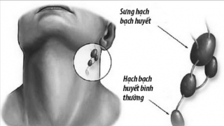 Bệnh lao hạch có lây không?