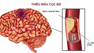 Cảnh báo gia tăng các cơn đột quỵ “tĩnh mạch não” hiếm gặp