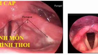 Triệu chứng và cách điều trị khàn tiếng trong mùa lạnh