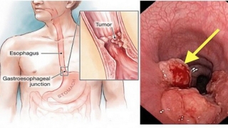 Làm thế nào để phân biệt giữa viêm họng mãn tính và ung thư thực quản giai đoạn đầu?