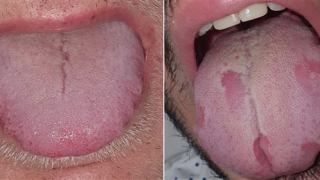'Covid lưỡi', triệu chứng mới của đại dịch