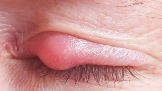 Làm thế nào để loại bỏ mụn trên mí mắt?
