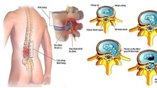 Mổ thoát vị đĩa đệm thắt lưng: Những câu hỏi thường gặp sau phẫu thuật