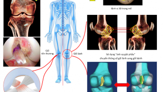 Vinmec tái tạo chính xác dây chằng chéo trước khớp gối với phương pháp “ánh xạ giải phẫu” độc quyền