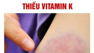 Dấu hiệu của việc thừa hay thiếu vitamin