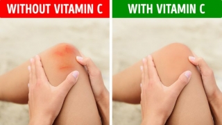 10 dấu hiệu sớm trên cơ thể cho thấy bạn đang thiếu vitamin C